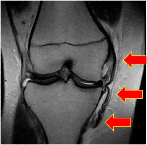 Coronal knee MRI showing a distal medial collateral ligament avulsed and displaced superficial to the pes anserinus