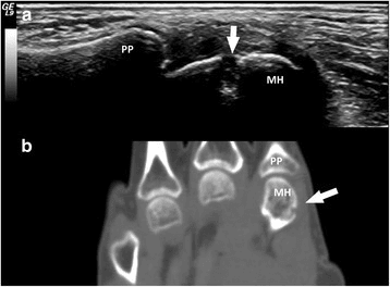 Longitudinal ultrasound and coronal CT of a second MCP joint showing a metacarpal-head erosion in rhupus syndrome
