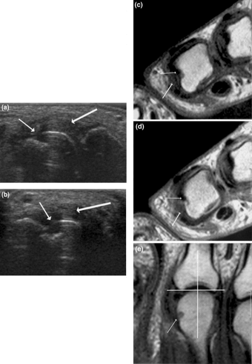 Ultrasound and MRI of the second MCP joint in established rheumatoid arthritis showing erosion and synovitis