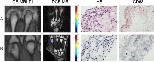 Contrast-enhanced MRI, DCE perfusion map, H and E histology and CD68 stain of high- versus low-grade MCP synovitis