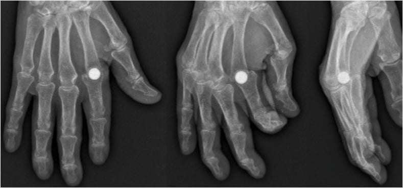 Postoperative MCP radiographs showing a spherical pyrocarbon implant decentered with a metacarpal lucent line, phalangeal erosion and proximal migration