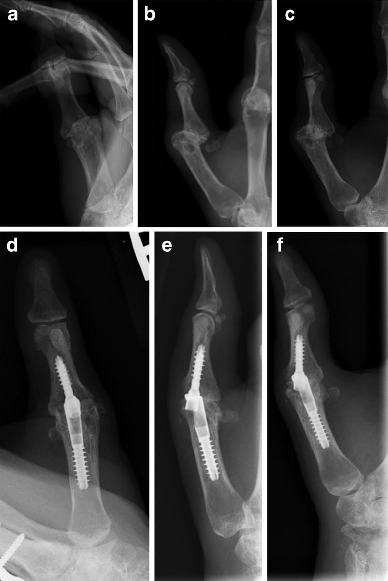 Preoperative AP, lateral and oblique thumb radiographs of rheumatoid MCP arthritis and instability, then postoperative fusion radiographs
