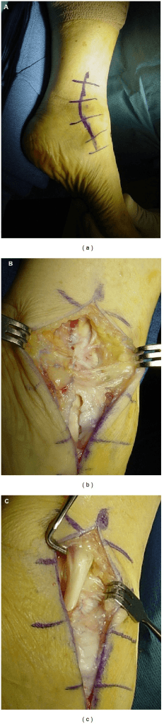 Intraoperative photographs of the medial approach to the ankle in three stages.
