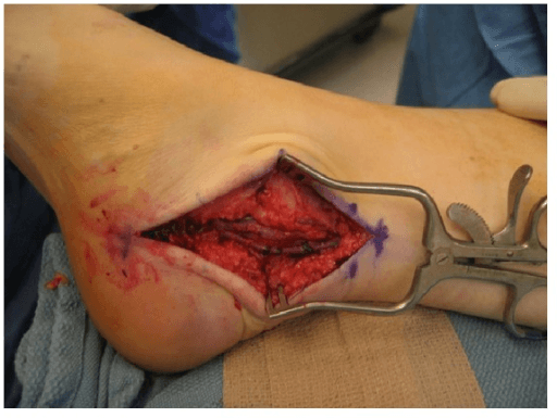 Intraoperative medial ankle exposure with a self-retaining retractor, showing deep dissection to the flexor hallucis longus tendon.