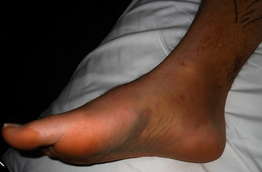 Clinical photograph of an acute medial ankle injury with ecchymosis and swelling.