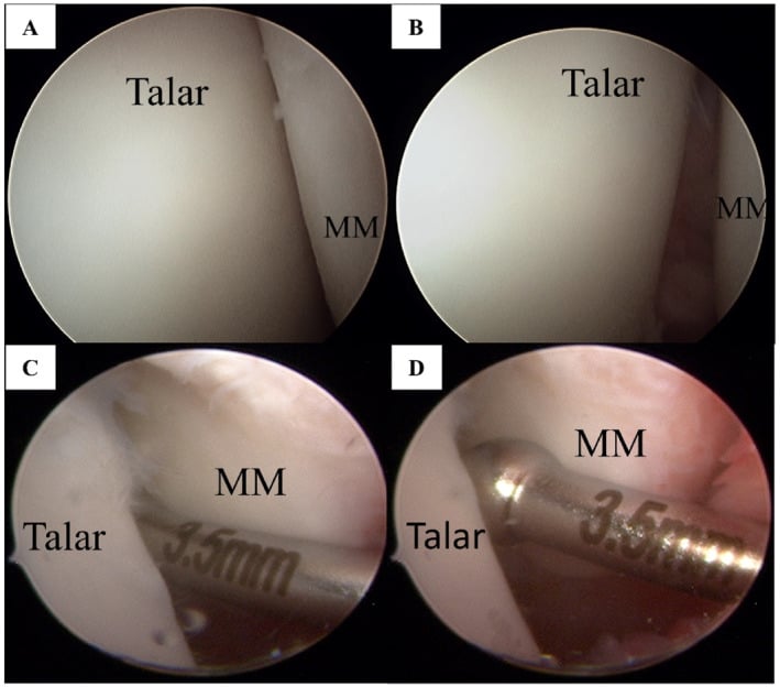 Arthroscopic medial gutter showing open-book gapping and passage of a 3.5 mm probe without traction