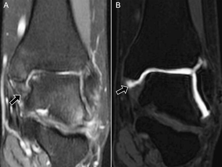 Coronal MRI and MR arthrogram showing a full-thickness deep deltoid ligament tear