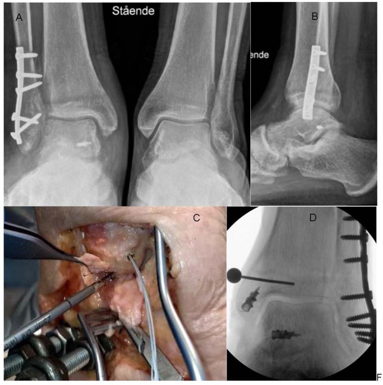 Radiographs, an open medial exposure and fluoroscopy of superficial and deep deltoid ligament suture-anchor repair