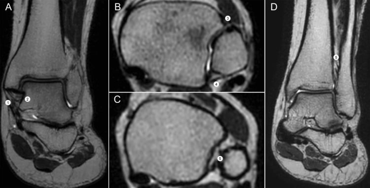 Four MRI panels (A-D) with numbered labels 1-5 marking the superficial and deep deltoid and the syndesmotic ligaments