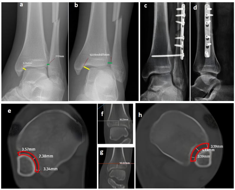 Mortise and gravity-assisted ankle stress radiographs showing medial clear-space and syndesmotic widening