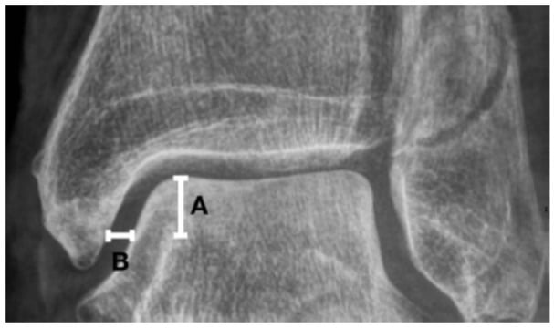 Mortise radiograph with bar B marking the medial clear-space measurement and bar A marking its level below the talar shoulder