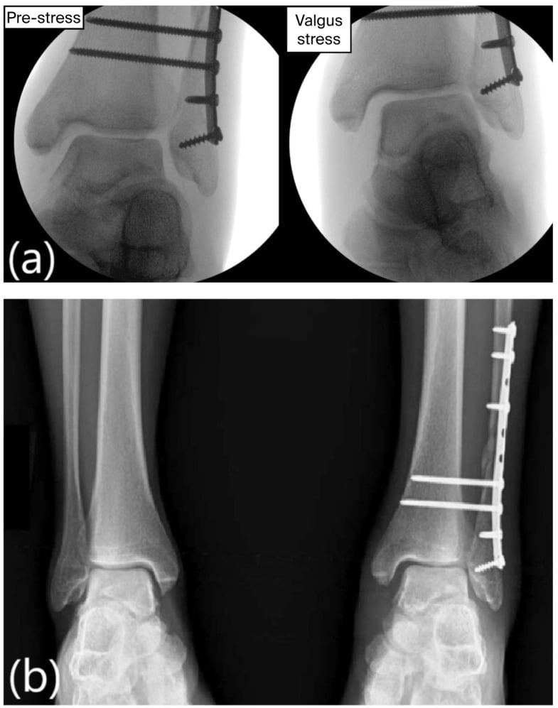 Valgus stress fluoroscopy and bilateral AP radiographs showing persistent medial instability after fracture fixation