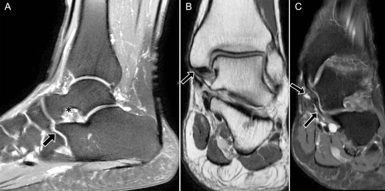 Multiplanar MRI showing partial tibiospring ligament tear and associated medial peritalar pathology