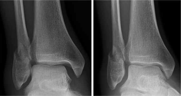 Non-weight-bearing and weight-bearing mortise radiographs showing medial clear-space widening that restores under load