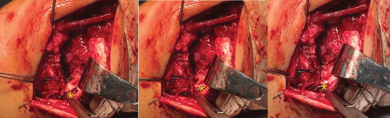 Three sequential intraoperative views of bone-tunnel suture tensioning in deltoid repair