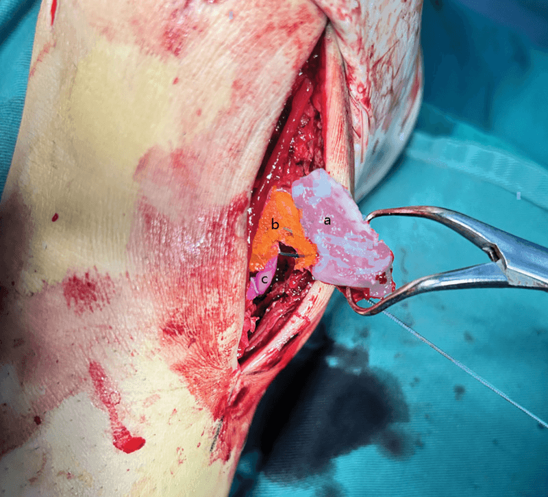 Operative view with labelled medial-malleolar fragment, deltoid ligament stump and posterior tibial tendon