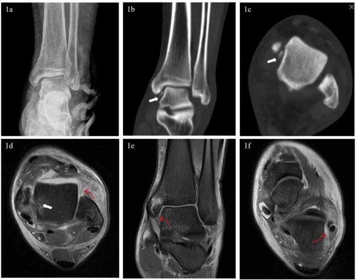 Radiograph, CT and MRI panels of one ankle with arrows marking a small medial bony fragment and associated findings