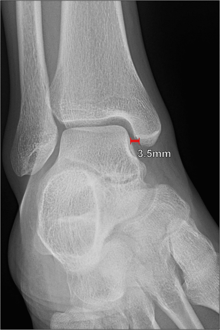 Mortise ankle radiograph showing medial clear space measurement