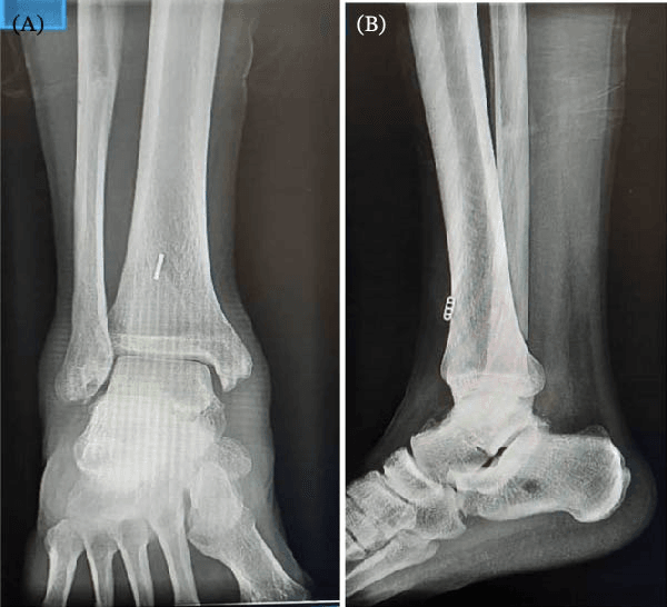 AP (A) and lateral (B) ankle radiographs without fracture in rotational instability