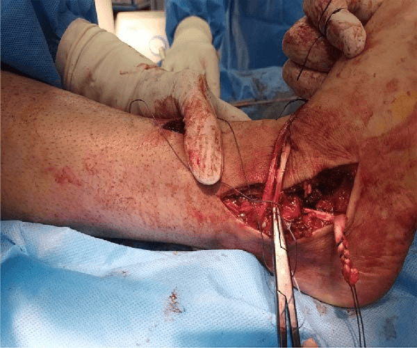 Operative close-up of allograft limbs being passed and tensioned in ankle multiligament reconstruction