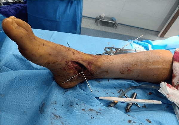 Intraoperative photograph of the ankle with K-wires marking planned reconstruction tunnels