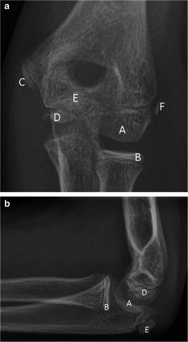 Anteroposterior and lateral radiographs of a normal ten-year-old elbow showing the ossification centres