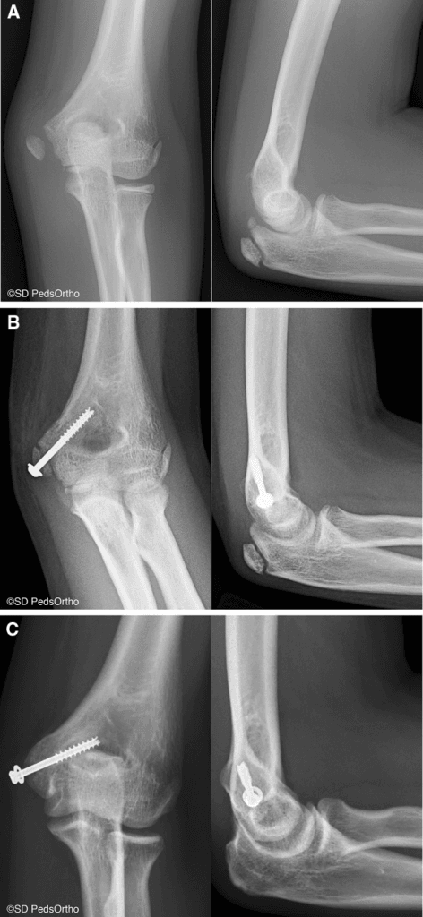Radiographs of a displaced medial epicondyle fracture before and after fixation