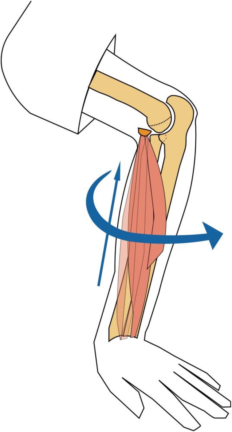 Schematic diagram of the avulsion mechanism of the medial epicondyle