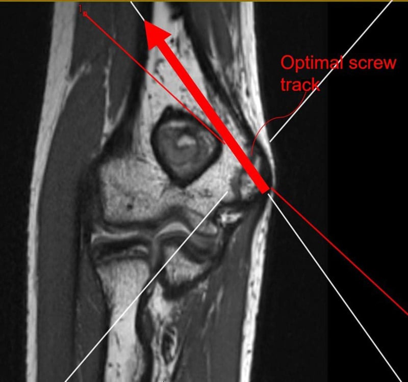 Coronal MRI showing the ideal medial epicondyle screw track and safe distances