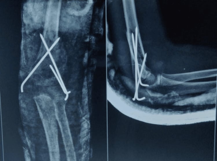 Postoperative anteroposterior and lateral radiographs showing anatomical reduction and implant placement