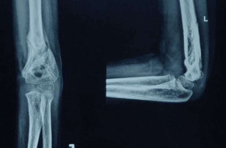 Anteroposterior and lateral radiographs at six weeks showing union after implant removal