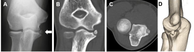 Radiographs and CT showing a small avulsed medial epicondyle fragment