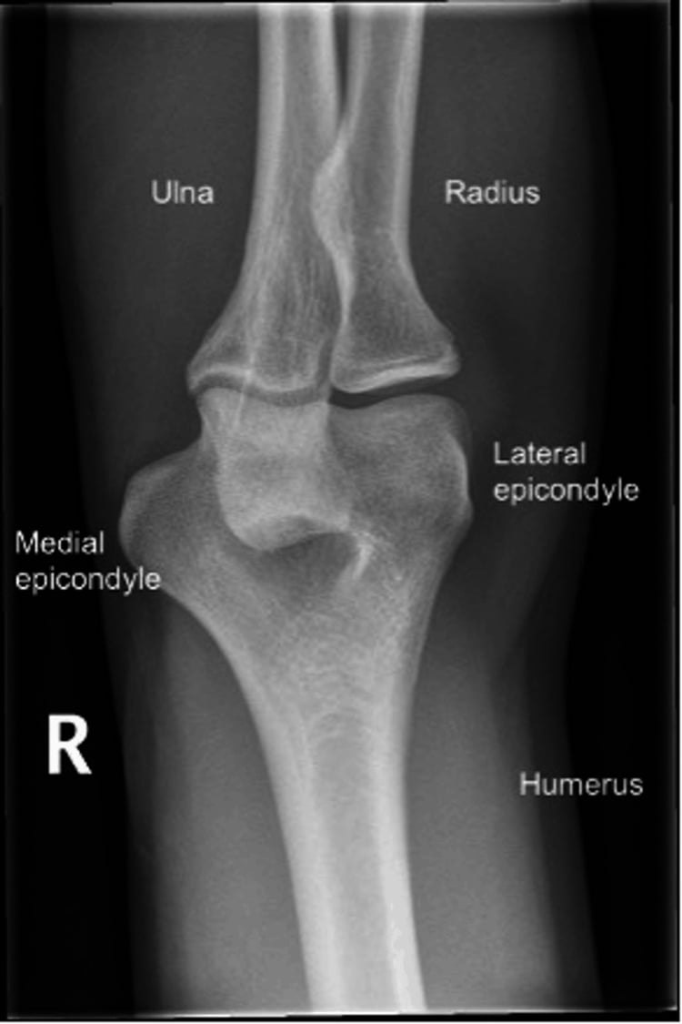 AP radiograph of the elbow evaluating medial epicondylar bone structures
