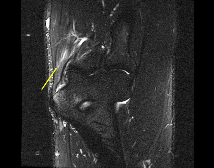 Coronal T2-weighted STIR MRI of the elbow showing hyperintense signal within the common flexor tendon fibres at the medial epicondyle