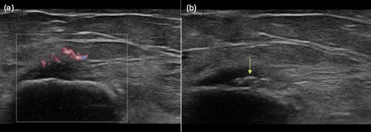 Ultrasound of the medial epicondyle showing reactive hyperaemia on Doppler and an intratendinous calcific focus