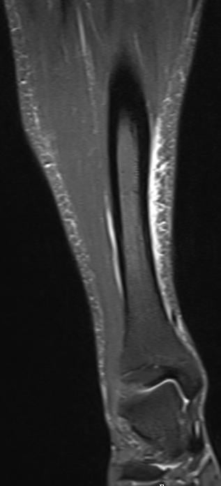 Coronal STIR MRI of the lower leg showing high signal along the medial tibia.