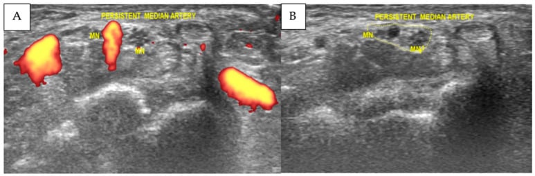 Transverse carpal tunnel ultrasound showing a bifid median nerve and persistent median artery on power Doppler.