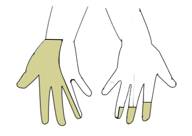 Diagram of the median nerve cutaneous sensory distribution on the palmar and dorsal hand.
