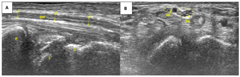 Long- and short-axis ultrasound views of the median nerve after treatment, showing a more uniform diameter and restored fascicular pattern.