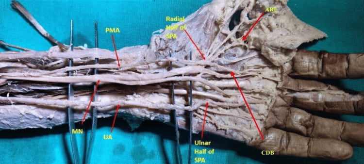 Cadaveric palmar view showing a palmar-type persistent median artery forming a radial incomplete superficial palmar arch.