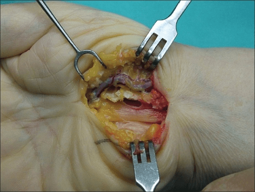 Intra-operative volar wrist dissection showing the radial artery passing superficial to the transverse carpal ligament.