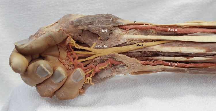 Cadaveric distal forearm and hand showing the median nerve, recurrent motor branch and radial and ulnar arteries.