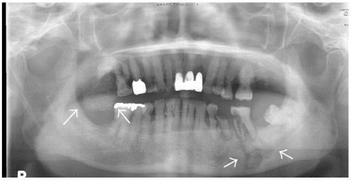 Medication-related osteonecrosis of the jaw - panoramic (OPG) radiograph of the mandible; arrows mark areas of osteonecrosis.