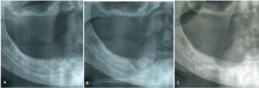 Three-panel series of mandibular radiographs labeled A, B, C showing progressive areas of radiolucency and sclerosis in the body of the mandible