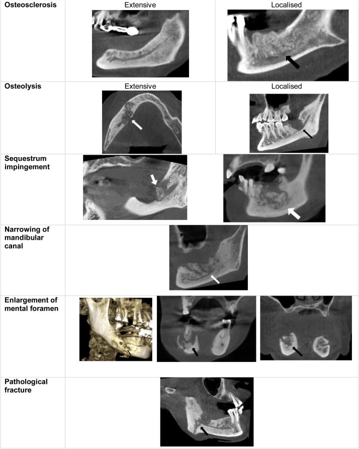 CBCT examples of osteosclerosis, osteolysis, sequestrum impingement, narrowing of the mandibular canal, mental foramen enlargement and pathological fracture