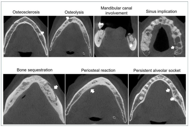 Cone beam CT panels showing osteosclerosis, osteolysis, mandibular canal involvement, sinus involvement, sequestration, periosteal reaction and persistent socket