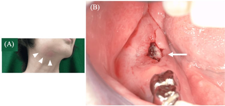 Submandibular swelling with redness alongside an intraoral view of a mucosal defect exposing necrotic bone at a molar site