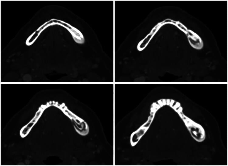 CT of the mandible showing a partially extruded bony sequestrum with cortical irregularity in the left paramedian body