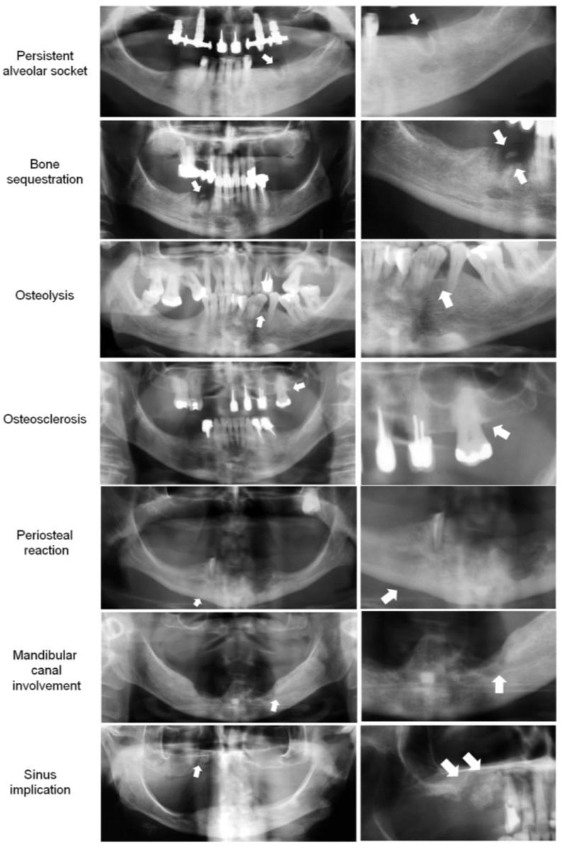 Panoramic radiographs with magnified views of persistent alveolar socket, sequestration, osteolysis, osteosclerosis, periosteal reaction, mandibular canal involvement and sinus involvement
