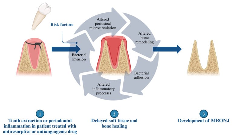 Schematic of the pathogenesis of MRONJ from extraction or periodontal inflammation through altered remodelling and bacterial invasion to exposed necrotic bone